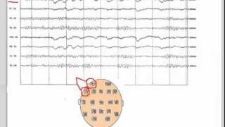 EEG  101 [upl. by Nilok714]