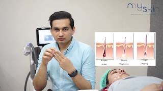 Laser hair removal face treatment at My Skin Lahore [upl. by Llecram190]