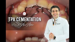 TPA transpalatal arch cementation in orthodontics [upl. by Bathesda]