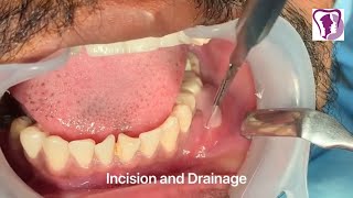 Incision and Drainage of Tooth Abscess Draining Pus [upl. by Cathe]