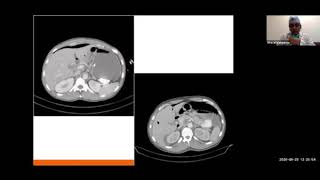 Anastomotic Leak in Colorectal Surgery [upl. by Etteniuqna]