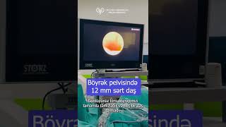 Böyrək daşı əməliyyatı Retrograde İntrarenal Surgery RİRS uroloq androloq [upl. by Cruz509]