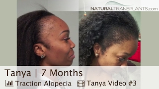 Best Female Hair Transplant Before and After  Hair Loss amp Traction Alopecia in Women Tanya [upl. by Rexer468]