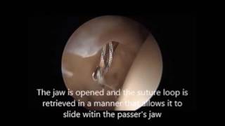 Labral Base Refixation of the acetabular labrum using the ACCUPASS DIRECT Suture Passer [upl. by Selwyn816]