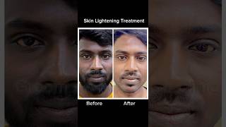 Skin Lightening Treatment  Before After Transformation 🔥🔥🔥 music tamil skincare tranformatio [upl. by Dranreb]