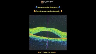 Serous macular detachment Central serous chorioretinopathy [upl. by Nairbal]