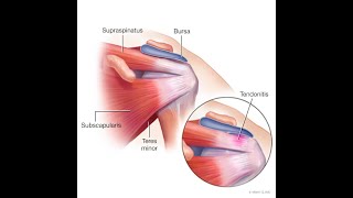 Tendonitis or Tendinitis  Definition causes Symptoms Diagnosis Treatment [upl. by Aiciles622]