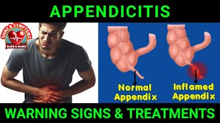 Appendicitis Symptoms and Treatment Options appendicitis [upl. by Noinatrad346]