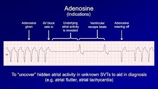 Antiarrhythmics Lesson 6  Digoxin Adenosine Atropine Isoproterenol and Ivabradine [upl. by Yreffoeg]