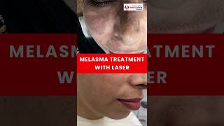 How to cure dark spots on Face  Melasma Treatment [upl. by Ahsiki]