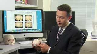 Craniosynostosis Treatment Options for Sagittal Synostosis  Part 5 of 6 [upl. by Earal576]