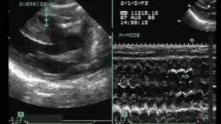 Tetralogy of Fallot with Vertically Oriented PDA [upl. by Opaline]