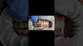 Lower implant molar bridge bite check with Bausch 40 micron articulating paper test shorts [upl. by Isborne]