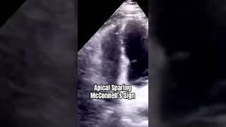 McConnell’s Sign echocardiography [upl. by Duong]