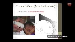 Neonatal Cranial Ultrasound Part 1 [upl. by Anneiv]