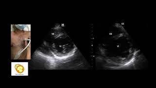 Curso de POCUS básico Charla de POCUS cardio Parte 2 [upl. by Ennagroeg]