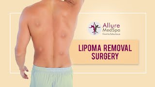 Multiple Lipoma Surgery Procedure at Allure Medspa  Mumbai [upl. by Ecirpac]