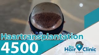 Haartransplantation Türkei  Bio Hair Clinic Istanbul  Mega Sitzung [upl. by Ihteerp]