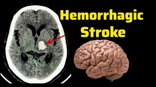 Hemorrhagic Stroke Brain bleed  CT Brain Radiology  Hemorrhage [upl. by Gretta]