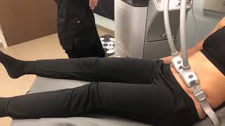 SculpSure Live Demo [upl. by Gudren]