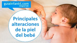 Sudamina y acné neonatal Principales alteraciones de la piel del bebé  Guiainfantil responde [upl. by Donald]