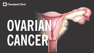 5 Warning Signs and Risk Factors of Ovarian Cancer [upl. by Zennas]