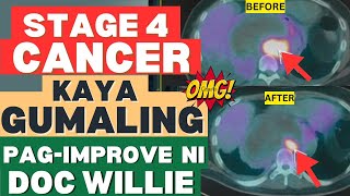 Stage 4 Cancer Kaya Pa Gumaling By Doc Willie Ong [upl. by Ytoc]