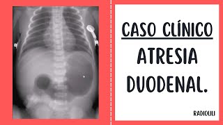 Caso Clínico 92 Atresia duodenal [upl. by Nima]