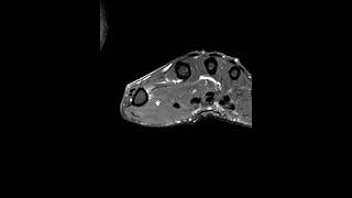 Extensor pollicis tendon longus EPL tendon rupture [upl. by Ayoj907]