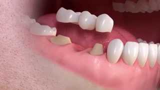 Straumann  Conventional 3unit bridge treatment [upl. by Naujad36]