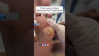 Ultimate Callus Removal Full Treatment For Smooth Feet  FootClinicLondoncouk [upl. by Assyla]