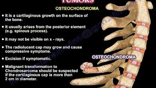 Cervical Spine Conditions TUMORS  Everything You Need To Know  Dr Nabil Ebraheim [upl. by Sidon647]