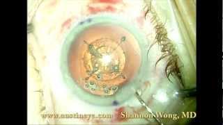 Lensx laser cataract surgery technique 122712 [upl. by Ycnaf]