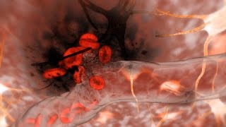 Hemorrhagic Stroke Brain Hemorrhage [upl. by Llerroj]