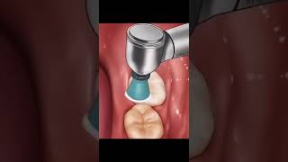 Composite restoration 3D Animation for Dentist Student 🦷💯 dentalstudent dentist shorts short [upl. by Ramsden662]