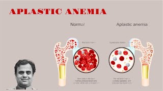 Aplastic Anemia [upl. by Ackler]