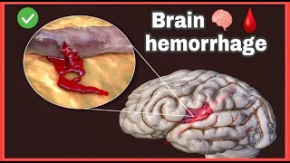 Brain hemorrhage 🧠🩸 [upl. by Robert]