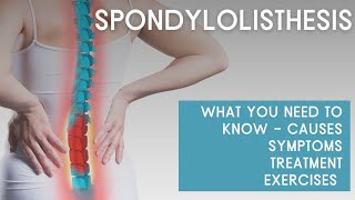 What you need to know about SPONDYLOLISTHESIS causes symptoms treatment exercises [upl. by Ahsienet]