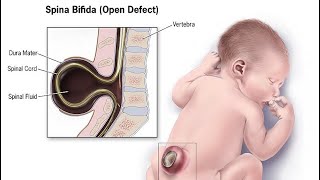 Spina Bifida 📚Spina bifida genetal defects Medical informations🩺📚spinabifidaawareness spinall [upl. by Ssyla332]