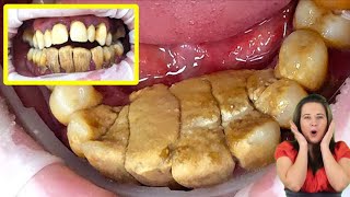 Cleaning and scaling teeth amp tartar amp calculus dentist dental dentista teethcare smileteethcare [upl. by Charlie977]