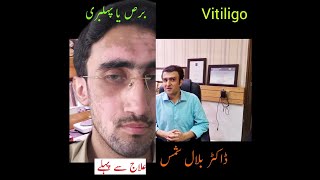 Vitiligo treatment  excimer laser  Dermatologist  Dr Bilal Shams [upl. by Anivek]