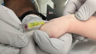 IV Insertion Technique in Infants and Small Children [upl. by Nnaik412]