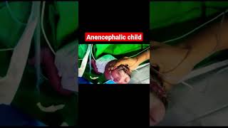 Anencephalic child bscnursing jlnmch [upl. by Norrat455]