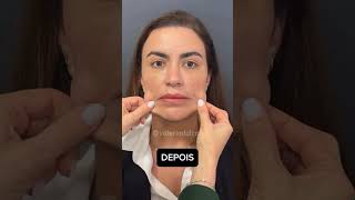 RESULTADO PROTOCOLLBIORECONEXÃO hof rejuvenescimentofacial bioestimuladordecolageno peeling [upl. by Liss]