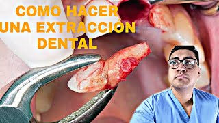 ¿COMO HACER UNA EXTRACCIÓN DENTAL 🦷 EN 6 MINUTOS 🤔 [upl. by Izy]