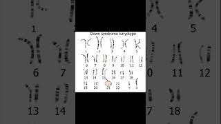 Downs syndrome Karyotype [upl. by Tommi529]