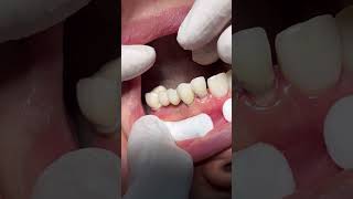 Fixed bridge dentist dental [upl. by Cimbura]