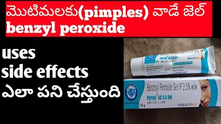 Benzoyl peroxide gel uses Telugupimplesacne treatment telugu [upl. by Haldane]