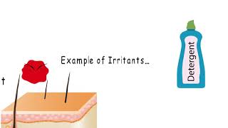 LOW DERMA™ Technology on Irritant Contact Dermatitis [upl. by Brigida]