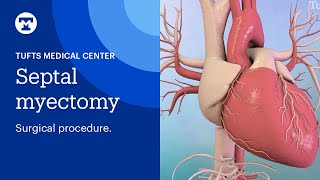 Septal Myectomy Surgical Procedure for Hypertrophic Cardiomyopathy HCM Tufts Medical Center [upl. by Jenne]